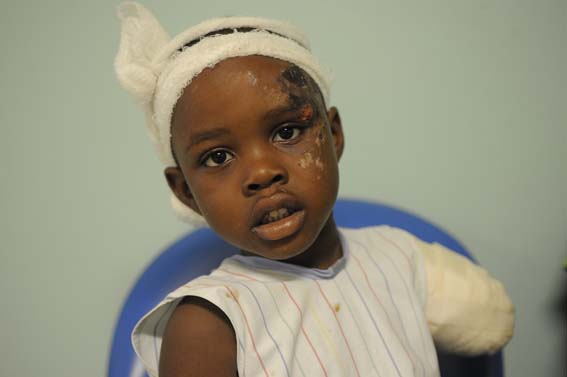 A girl injured as a result of the earthquake. Source: Our Little Brothers Foundation