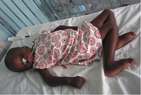 Patient at St. Damien's hospital. Source: Our Little Brothers Foundation