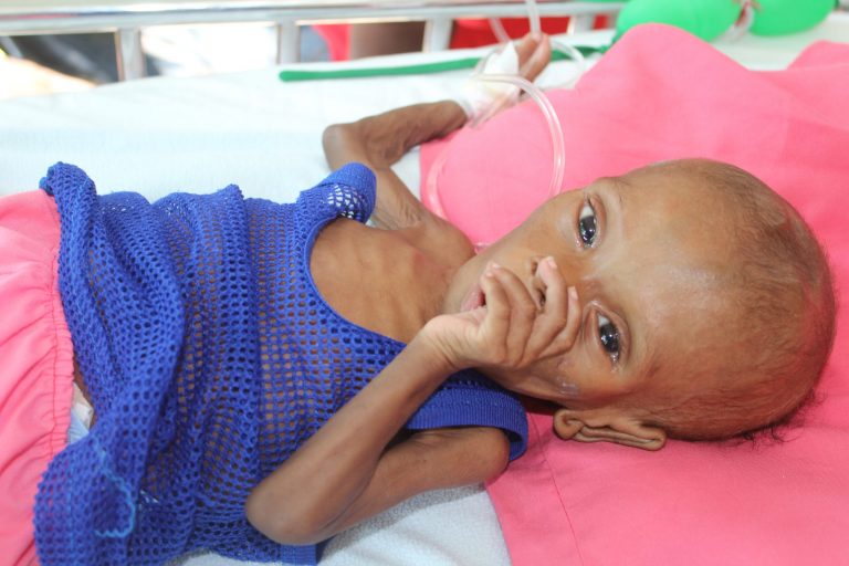 Acute malnourished girl admitted to St. Damien Hospital. Source: Our Little Brothers Foundation